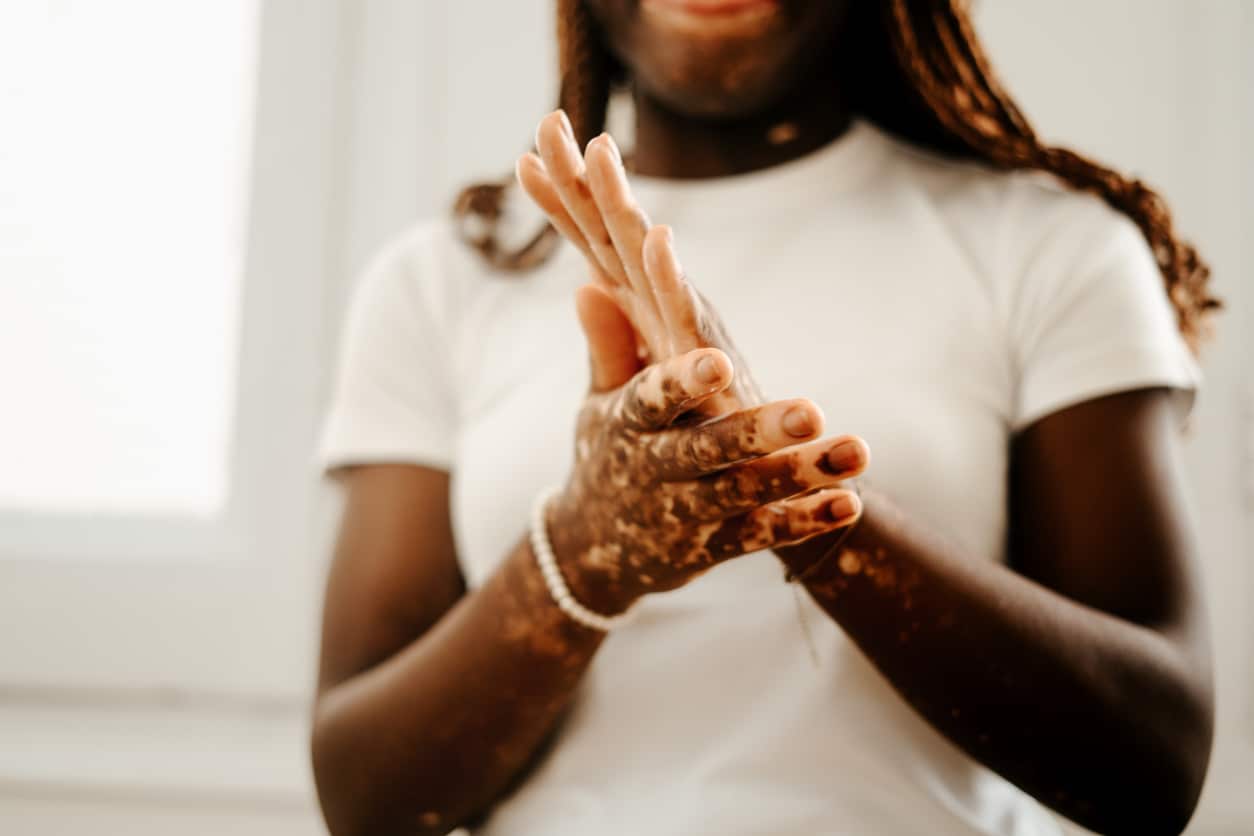 Close-up of a woman's hands with vitiligo