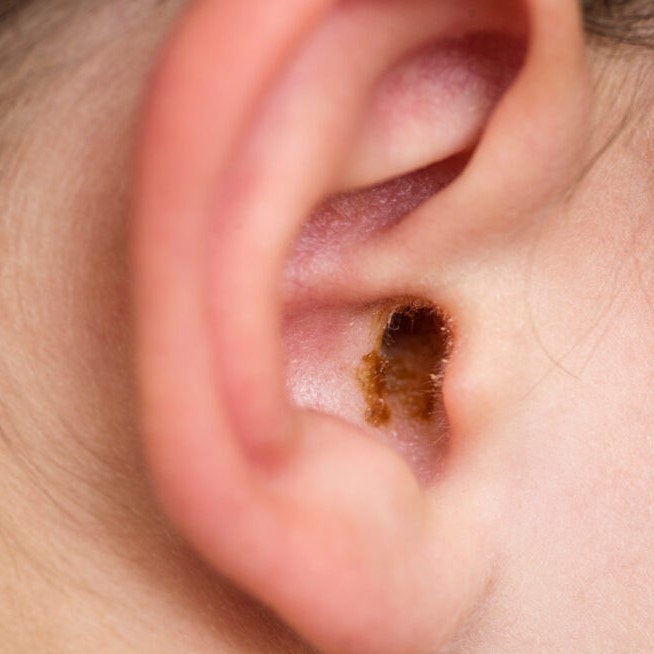 Close up of ear with orange earwax